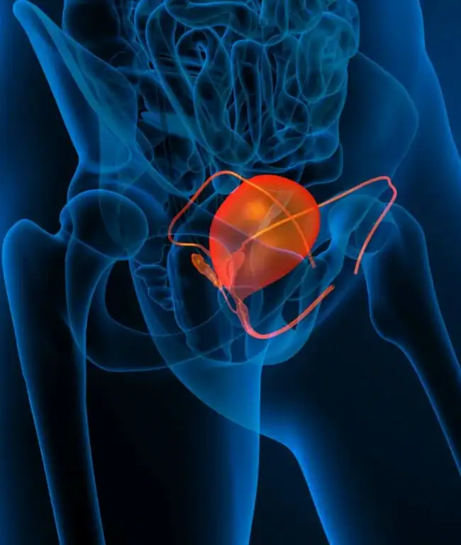 Medical illustration showing the human pelvis with the urinary bladder highlighted in orange and surrounding blood vessels visible, depicting anatomy often involved in bladder control and urinary incontinence.